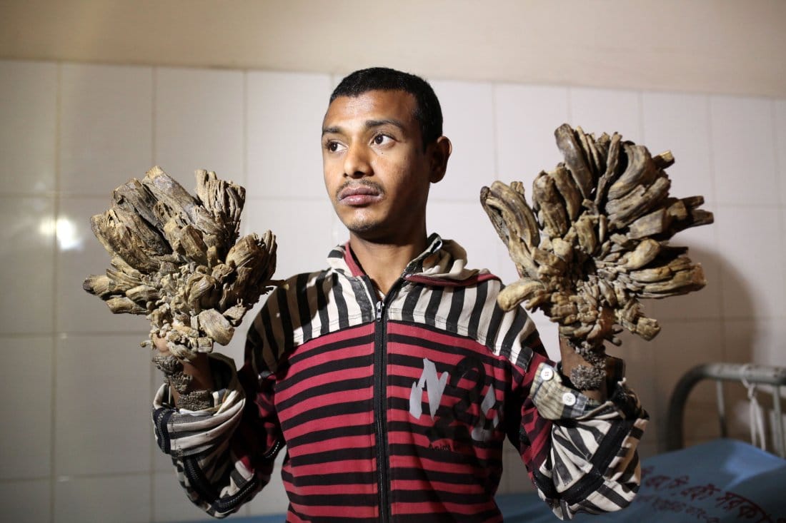 അബുൾ ബജന്ദാർ ഇനി വൃക്ഷ മനുഷ്യൻ അല്ല