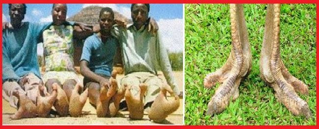 ഒട്ടകപ്പക്ഷിയുടെ പോലത്തെ കാലുമായി ജനിക്കുന്നവര്‍