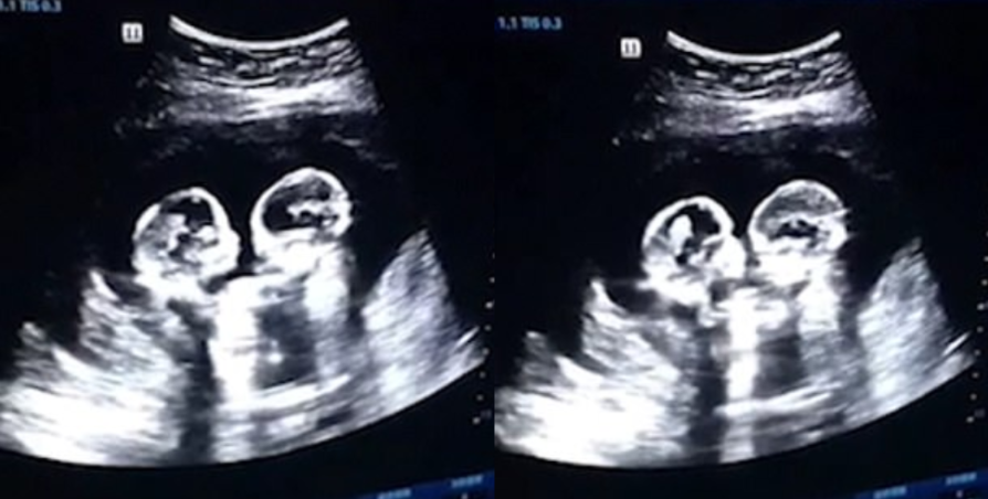 അമ്മയുടെ  ഗർഭപാത്രത്തിലിരുന്ന്  അടികൂടി  ചെറിയും  സ്ട്രോബെറിയും; വീഡിയോ വൈറൽ