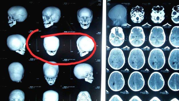 പ്രതീക്ഷകൾക്ക്  വിട; തൊടുപുഴയില്‍ മര്‍ദനമേറ്റ കുട്ടിക്ക് മസ്തിഷ്‌ക മരണം സംഭവിച്ചതായി ഡോക്ടർമാരുടെ റിപ്പോർട്ട്