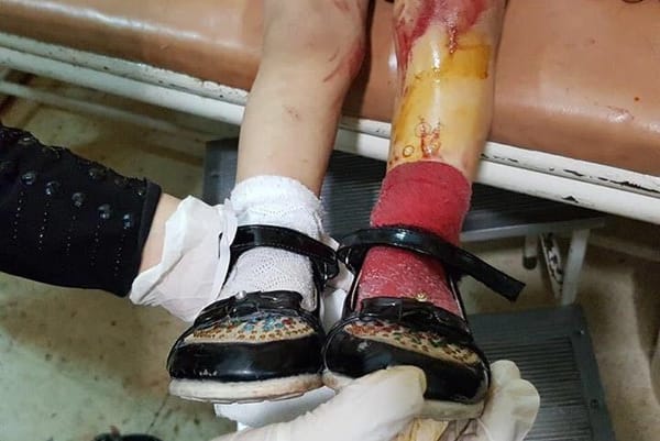 കൊല്ലത്ത് സ്കൂളിലെ മാലിന്യ ടാങ്ക് തകർന്ന് കുട്ടികൾ ഉള്ളിൽ വീണു; അഞ്ച് പേർക്ക് പരുക്ക്