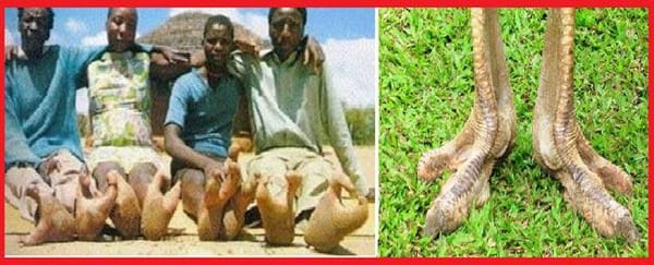 ഒട്ടകപ്പക്ഷിയുടെ പോലത്തെ കാലുമായി ജനിക്കുന്നവര്‍