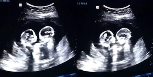 അമ്മയുടെ  ഗർഭപാത്രത്തിലിരുന്ന്  അടികൂടി  ചെറിയും  സ്ട്രോബെറിയും; വീഡിയോ വൈറൽ