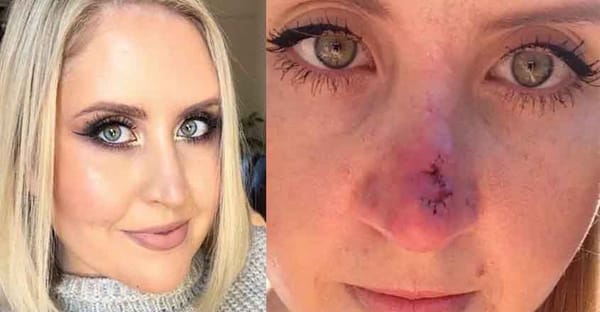 മുഖ കുരുവാണെന്ന്  കരുതി  കുത്തി പൊട്ടിച്ചു; പരിശോധിച്ചപ്പോൾ മാരകകാൻസർ