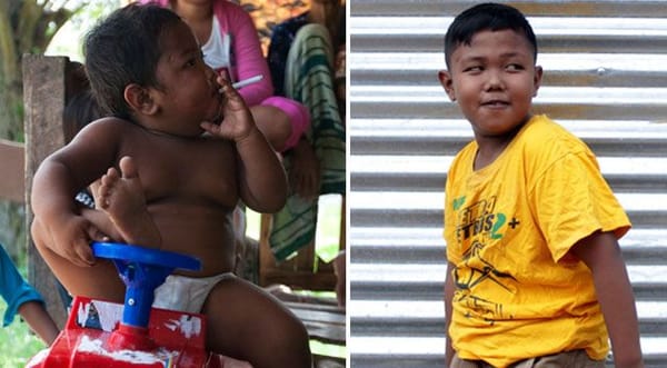 രണ്ടു വയസുള്ളപ്പോള്‍ ദിവസം 40 സിഗരറ്റുകള്‍ വരെ വലിച്ചിരുന്ന ആ ഇന്തോനേഷ്യന്‍ ബാലന്റെ ഇപ്പോഴത്തെ അവസ്ഥ ഇതാണ്